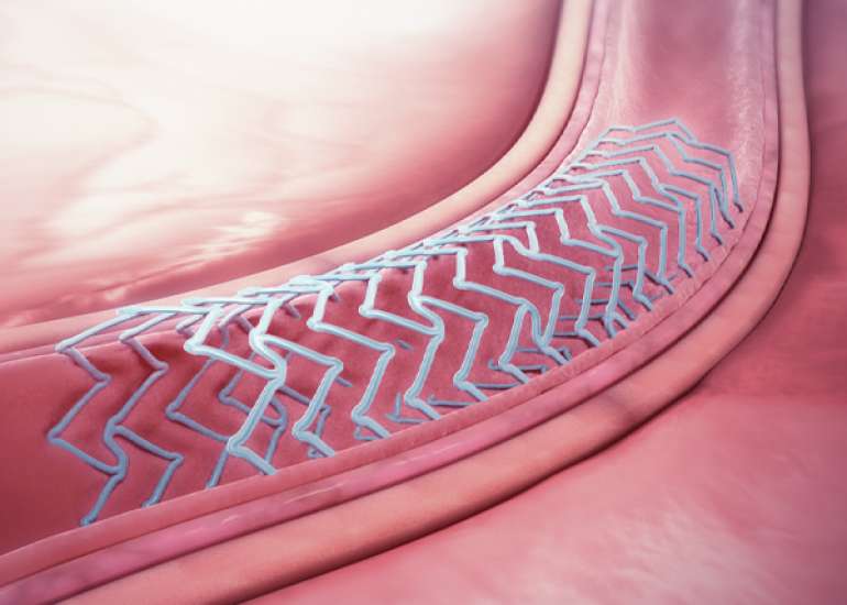 What is the role of absorbable stents in acute MI?