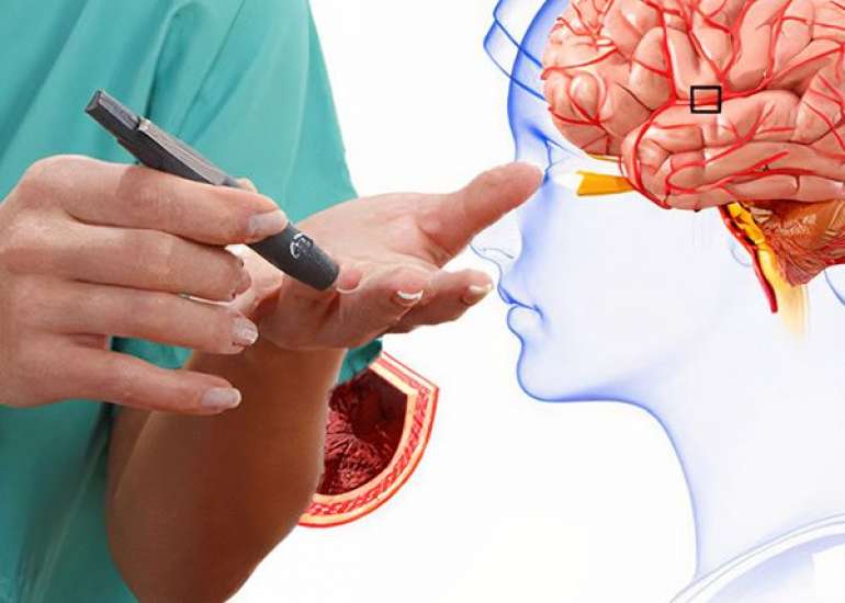 मधुमेह संबंधित स्ट्रोक क्या है? कारण, लक्षण और इलाज | Diabetes Related Stroke in Hindi