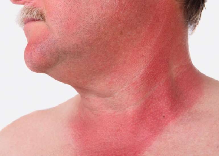 सनबर्न क्या है? कारण, लक्षण और इलाज | Sunburn in Hindi