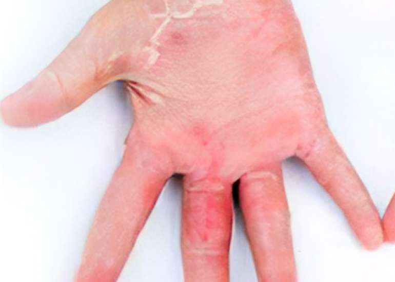 Short-Term Outcome and Management of TSS in Children