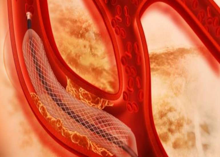 What are the third generation stents?