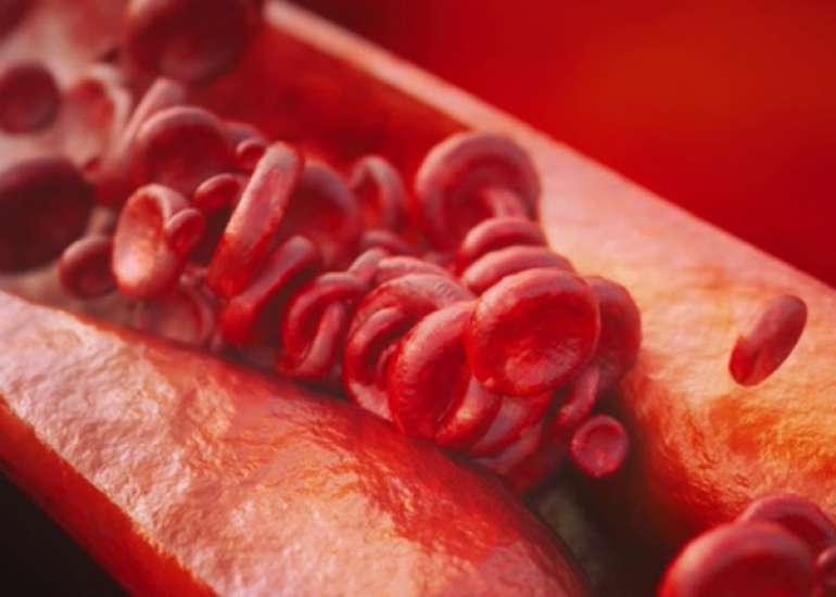 What is the role of ticlopidine in acute MI?