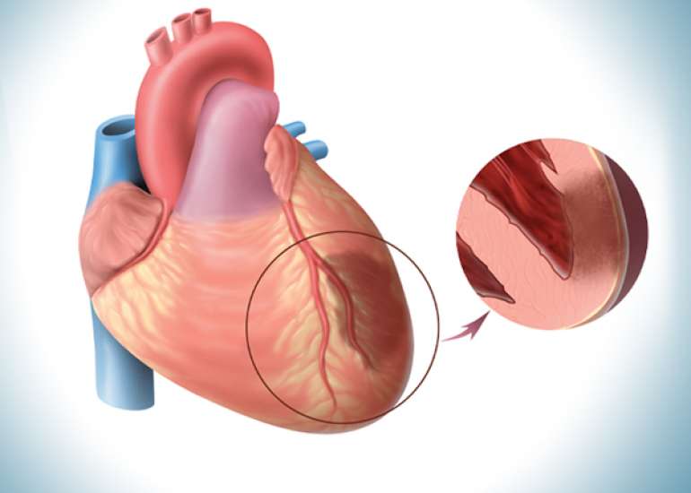 When should we use tirofiban in acute MI?