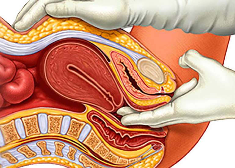 What is the treatment of polycystic ovary?