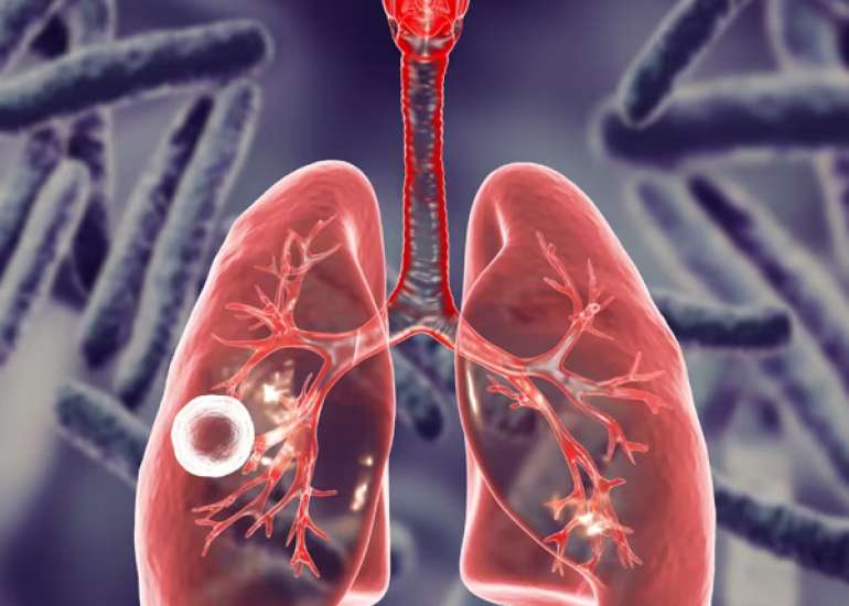 Tuberculosis: Transmission and Treatment