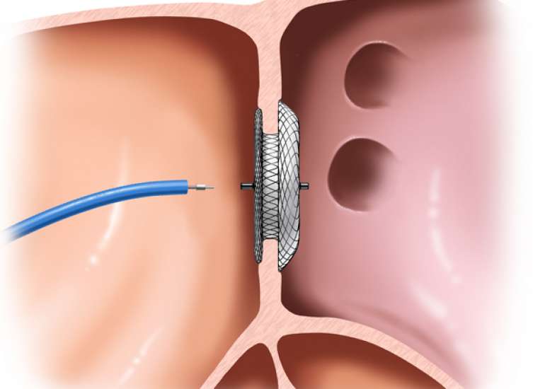 What is the management of triple vessel disease?