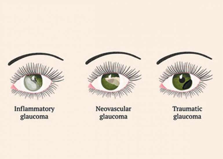 What are the type of glaucoma?