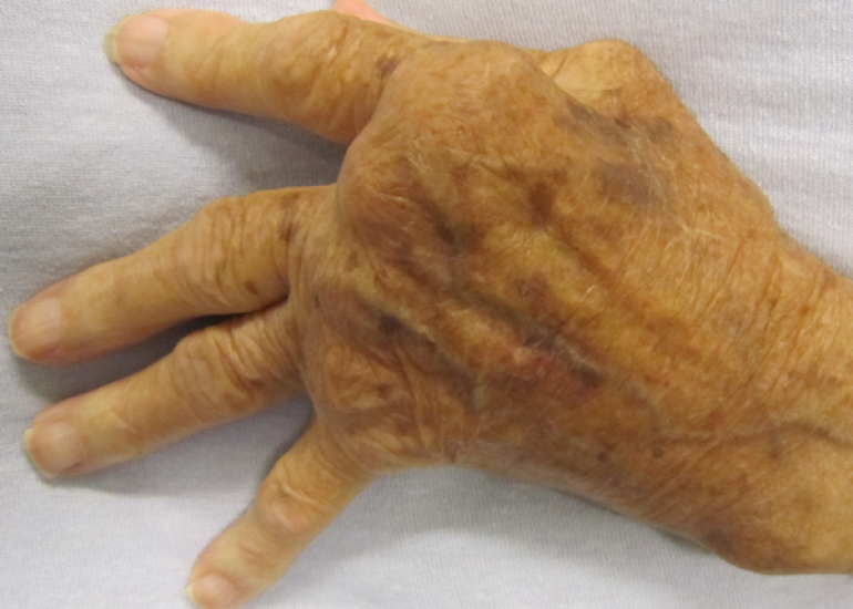 Types of Viruses that Can Cause Arthritis From Hepatitis C to Chikungunya