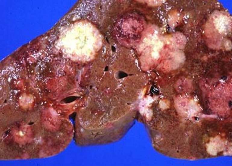 Liver Disorders in India: Understanding the Prevalence