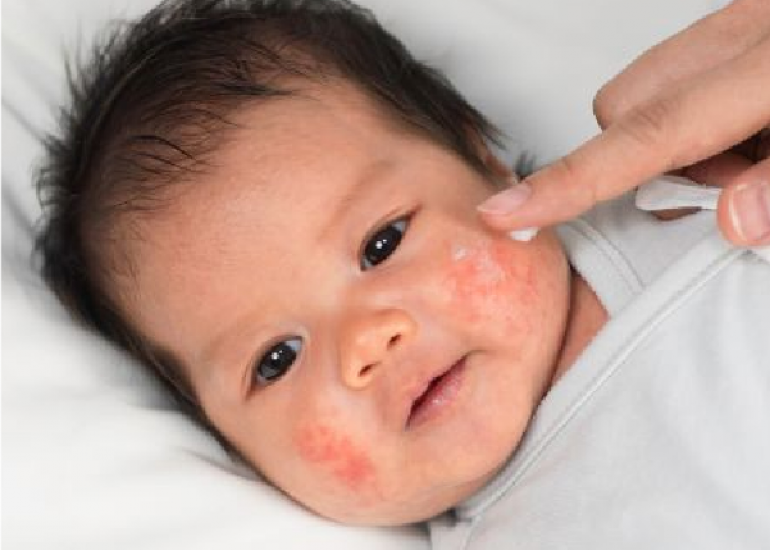 Atopic Dermatitis: An update for parents