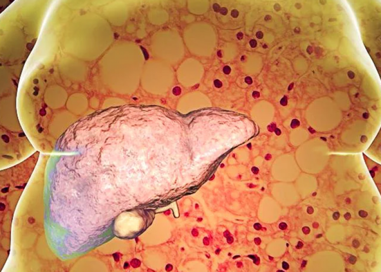 लीवर रोग क्या हैं? कारण, लक्षण और इलाज | What are Liver Diseases in Hindi