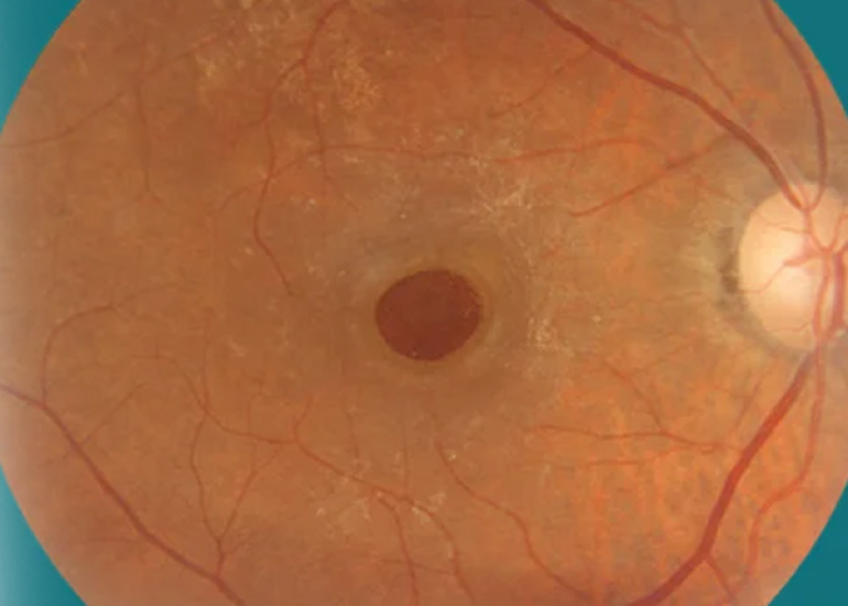 मैक्यूलर होल क्या है? कारण, लक्षण और इलाज | What is a Macular Hole in Hindi