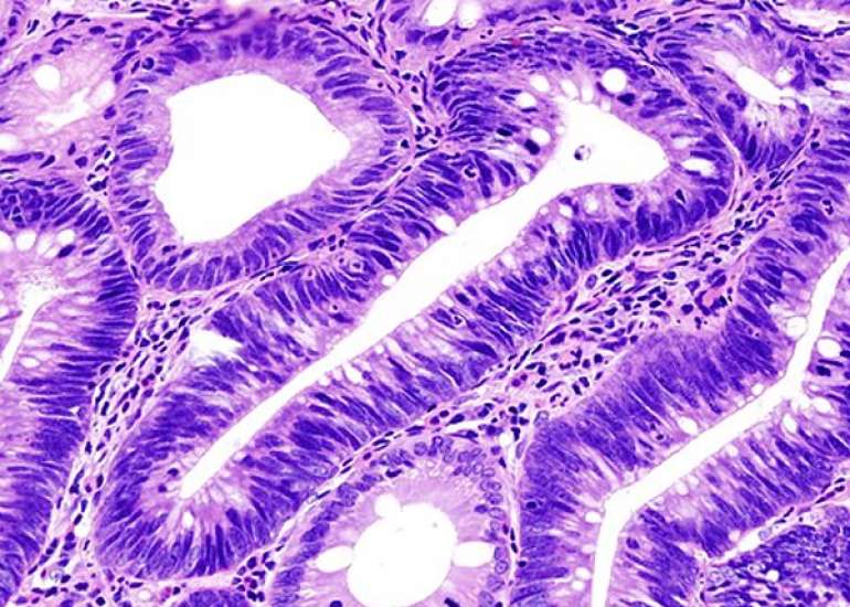 एडेनोमास क्या हैं? कारण, लक्षण और इलाज | What is Adenomas in Hindi