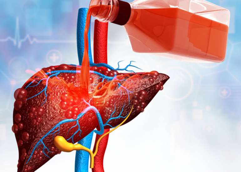 अल्कोहलिक हेपेटाइटिस क्या है? कारण, लक्षण और इलाज | What is Alcoholic Hepatitis in Hindi