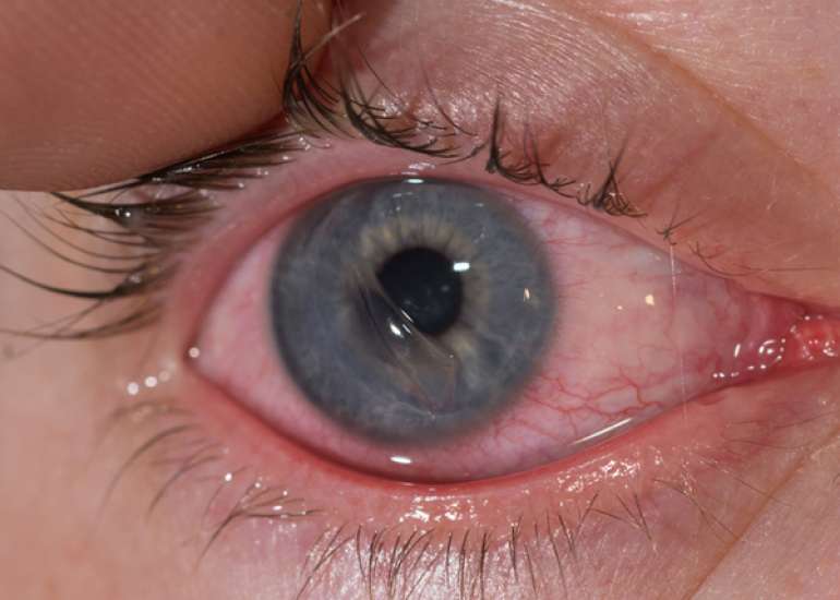 कॉर्नियल घर्षण क्या है? कारण, लक्षण और इलाज | What is Corneal Abrasion in Hindi