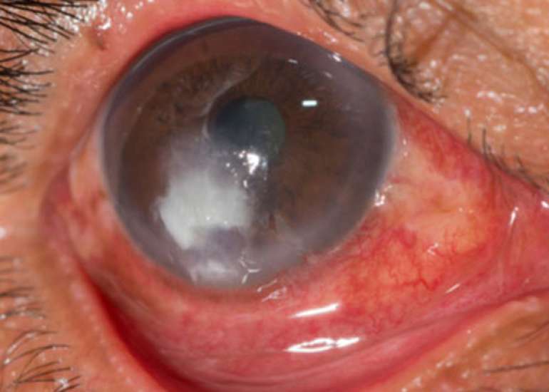 कॉर्नियल अल्सर क्या है? कारण, लक्षण और इलाज | What is Corneal Ulcer in Hindi