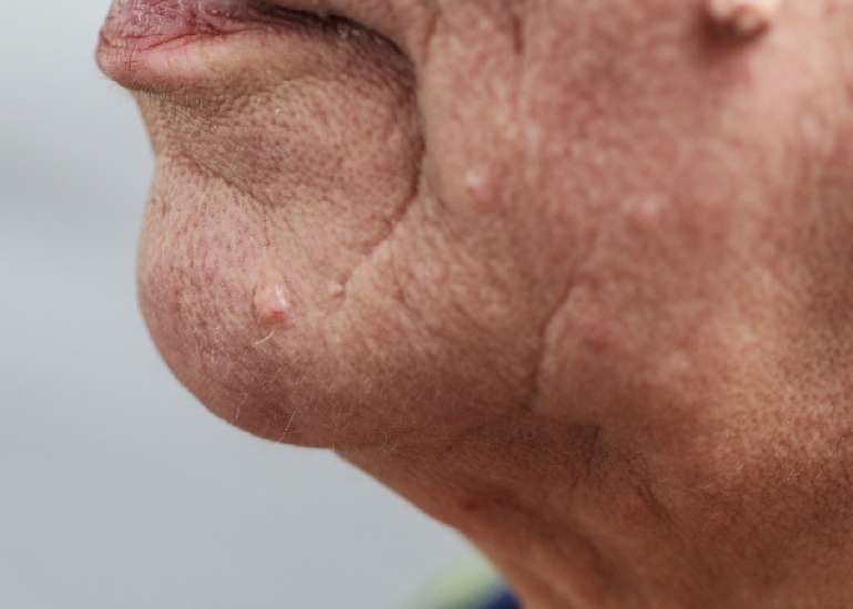 फाइब्रोमा क्या है? कारण, लक्षण और इलाज | What is Fibroma in Hindi