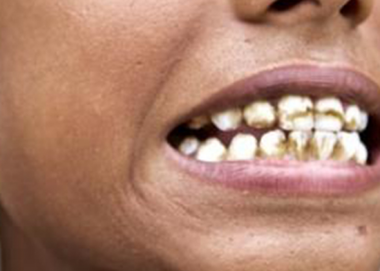 फ्लोरोसिस क्या है? कारण, लक्षण औरी इलाज | What is Fluorosis in Hindi