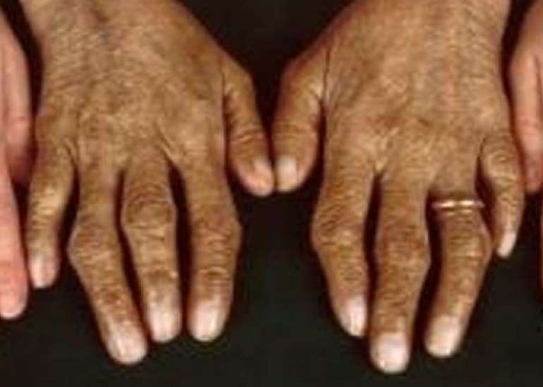 हेमोक्रोमैटोसिस क्या है? कारण, लक्षण और इलाज | What is Hemochromatosis in Hindi