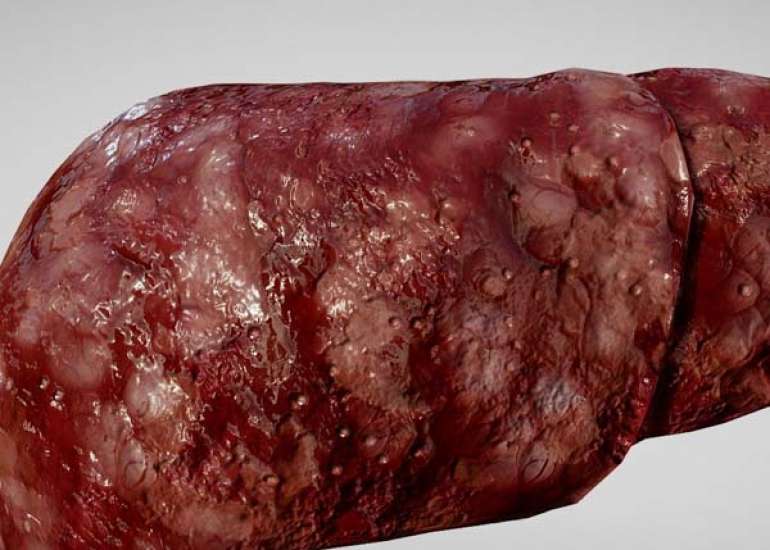 हेपैटोसेलुलर कार्सिनोमा (एचसीसी) क्या है? कारण, लक्षण और इलाज | What is Hepatocellular Carcinoma (HCC) in Hindi