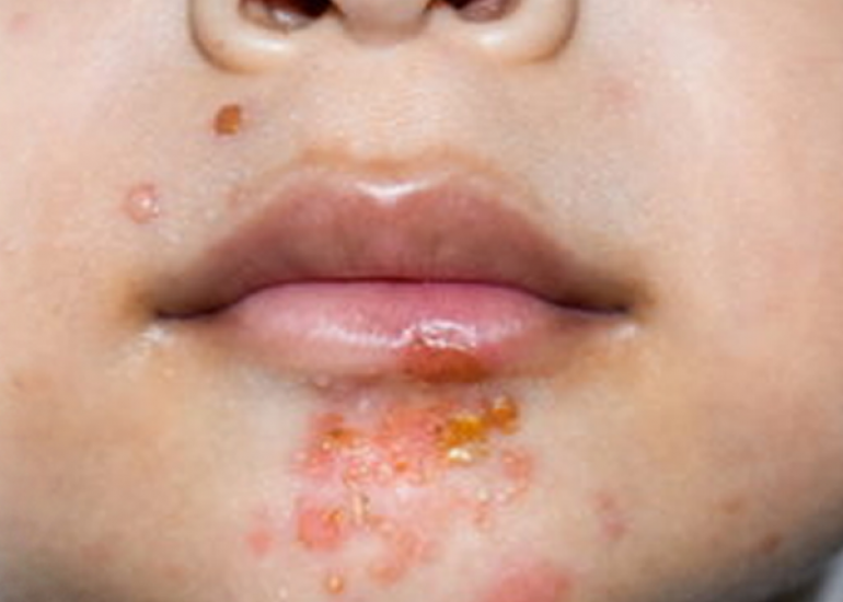 इम्पेटिगो क्या है? कारण, लक्षण और इलाज | What is Impetigo in Hindi