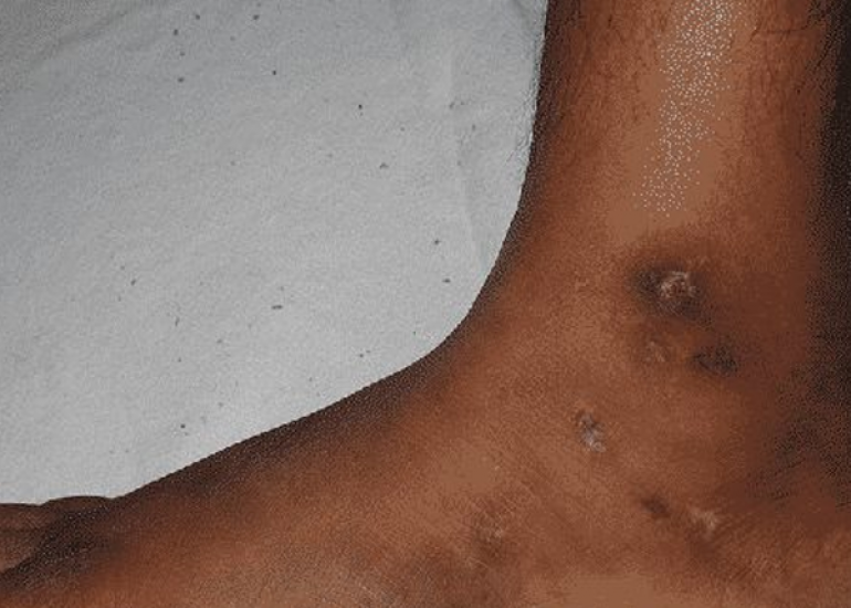 कपोसी सरकोमा क्या है? कारण, लक्षण और इलाज | What is Kaposi Sarcoma in Hindi