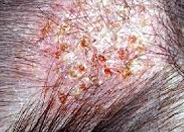 केरियन क्या है? कारण, लक्षण और इलाज | What is Kerion in Hindi