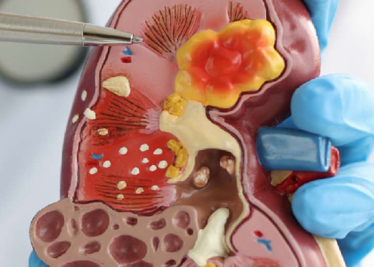 किडनी ट्यूमर क्या है? कारण, लक्षण और इलाज | What is Kidney Tumor in Hindi