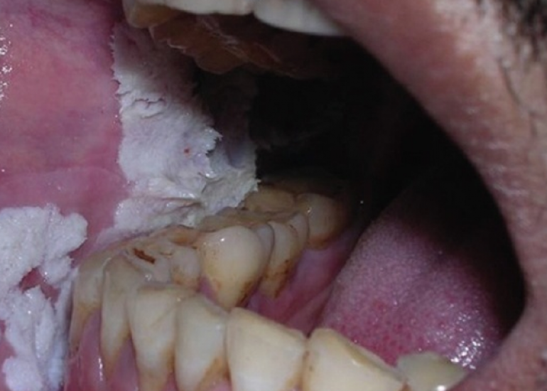 ल्यूकोप्लाकिया क्या है? कारण, लक्षण और इलाज | What is Leukoplakia in Hindi