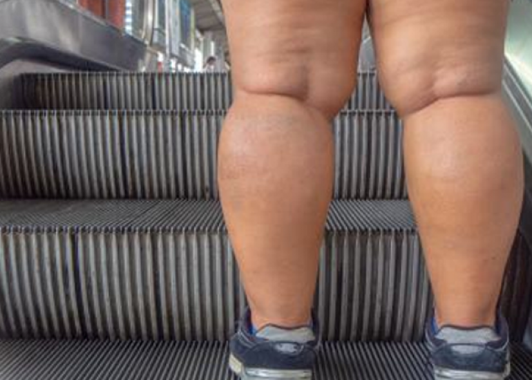 लिपिडेमा क्या है? कारण, लक्षण और इलाज | What is Lipedema in Hindi