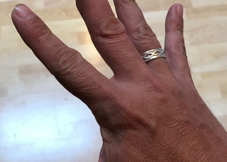 मैलेट फिंगर क्या है? कारण, लक्षण और इलाज | What is Mallet Finger in Hindi