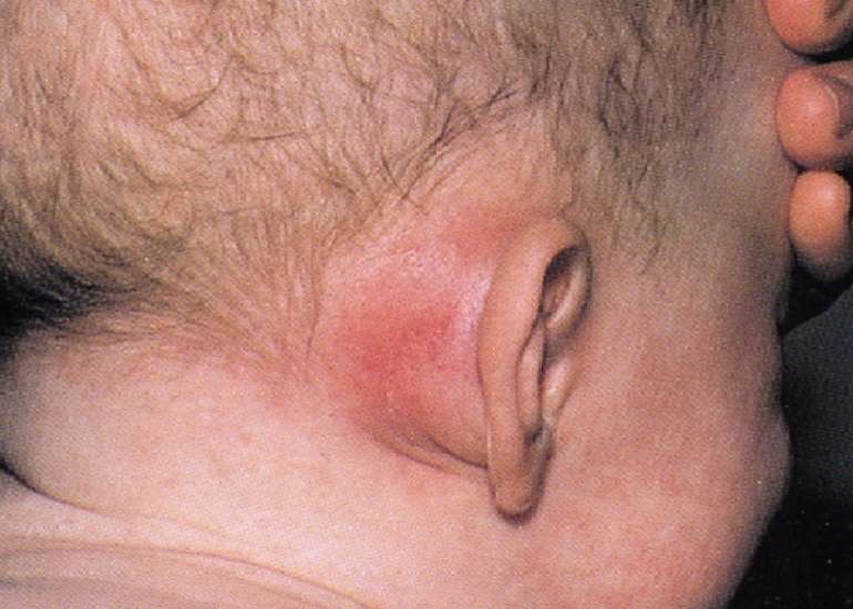 मास्टॉयडाइटिस क्या है? कारण, लक्षण और इलाज | What is Mastoiditis in Hindi