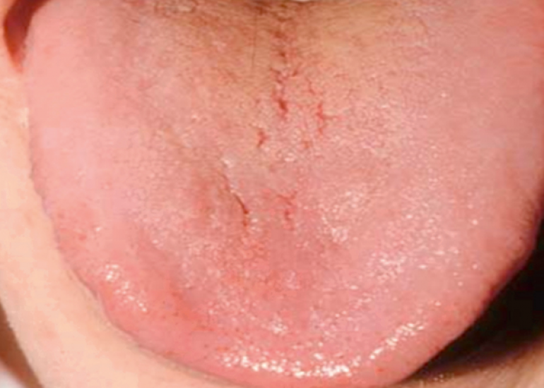 मेगालोब्लास्टिक एनीमिया क्या है? कारण, लक्षण और इलाज | What is Megaloblastic Anemia in Hindi