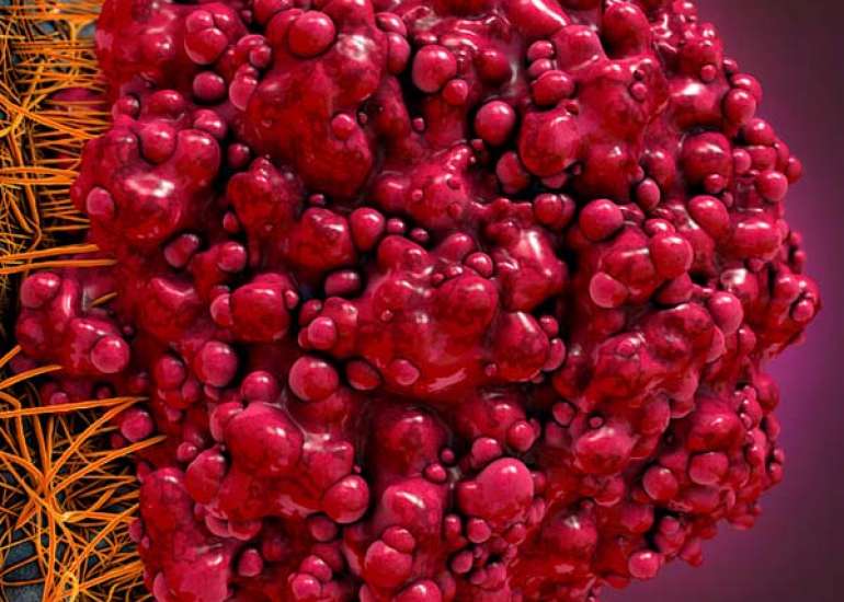 मेटास्टैटिक कैंसर क्या है? कारण, लक्षण और इलाज | What is Metastatic Cancer in Hindi