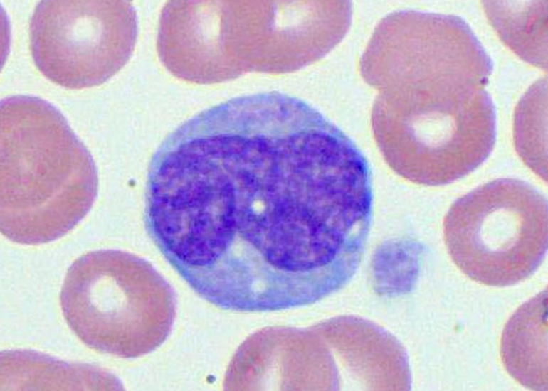 मोनोसाइटोसिस क्या है? कारण, लक्षण और इलाज | What is Monocytosis in Hindi