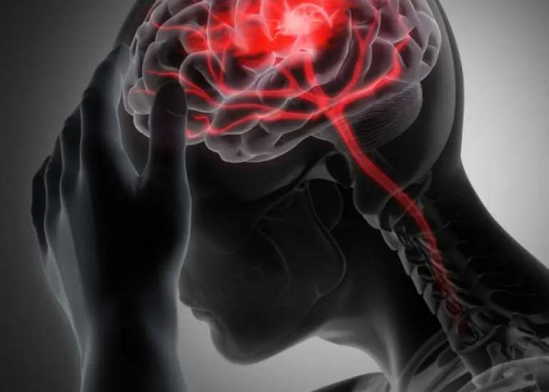 मोयामोया रोग क्या है? कारण, लक्षण और इलाज | What is Moyamoya Disease in Hindi