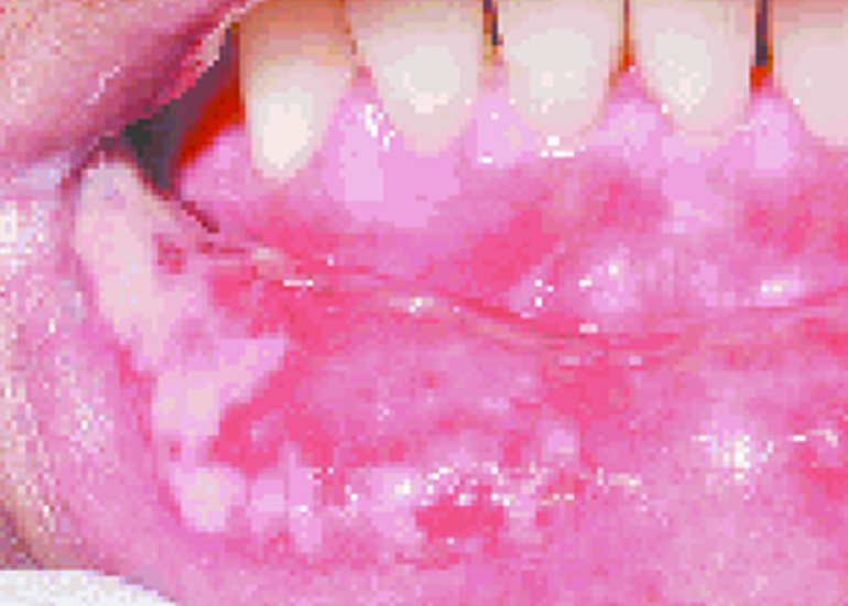 म्यूकोसाइटिस क्या है? कारण, लक्षण और इलाज | What is Mucositis in Hindi