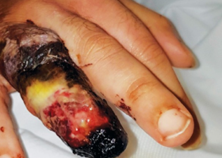 नेक्रोसिस क्या है? | What is Necrosis in Hindi