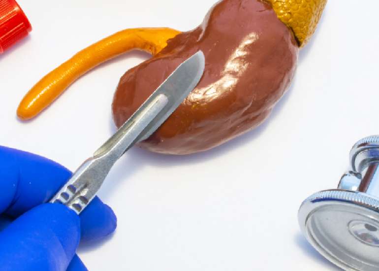 नेफरेक्टोमी क्या है? | What is Nephrectomy in Hindi