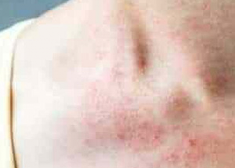 न्यूट्रोपेनिया क्या है? कारण, लक्षण और इलाज | What is Neutropenia in Hindi