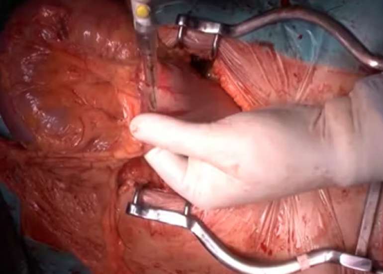 ओमेंटम कैंसर क्या है? कारण, लक्षण और इलाज | What is Omentum Cancer in Hindi