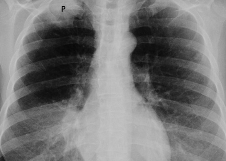 पैनकोस्ट ट्यूमर क्या है? कारण, लक्षण और इलाज | What is Pancoast Tumor in Hindi