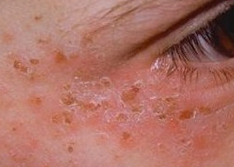 पोर्फिरीया क्या है? कारण, लक्षण और इलाज | What is Porphyria in Hindi