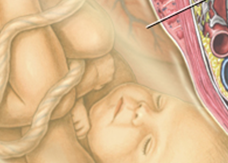 पॉटर सिंड्रोम क्या है? कारण, लक्षण और इलाज | What is Potter Syndrome in Hindi