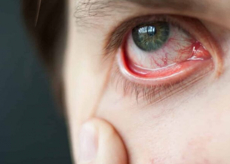 प्रेसबायोपिया क्या है? कारण, लक्षण और इलाज | What is Presbyopia in Hindi