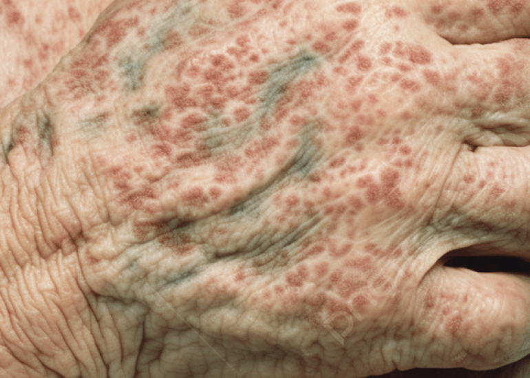 रोजोला क्या है? कारण, लक्षण और इलाज | What is Roseola in Hindi