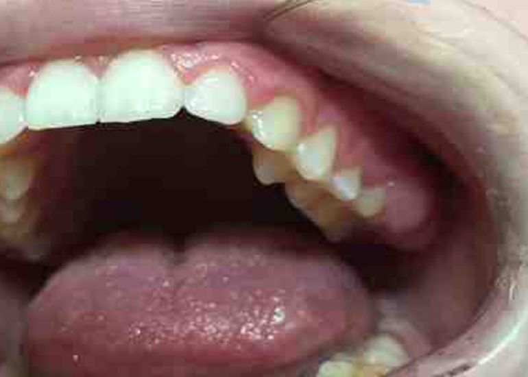 लार ग्रंथि का कैंसर क्या है? कारण, लक्षण और इलाज | What is Salivary Gland Cancer in Hindi