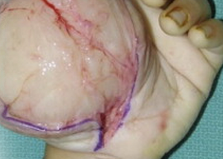 श्वान्नोमा क्या है? कारण, लक्षण और इलाज | What is Schwannoma in Hindi