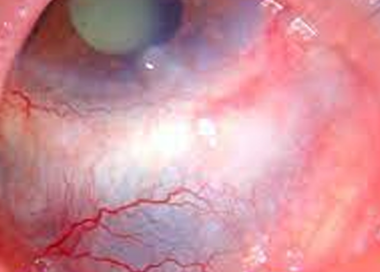 स्केलेराइटिस क्या है? कारण, लक्षण और इलाज | What is Scleritis in Hindi