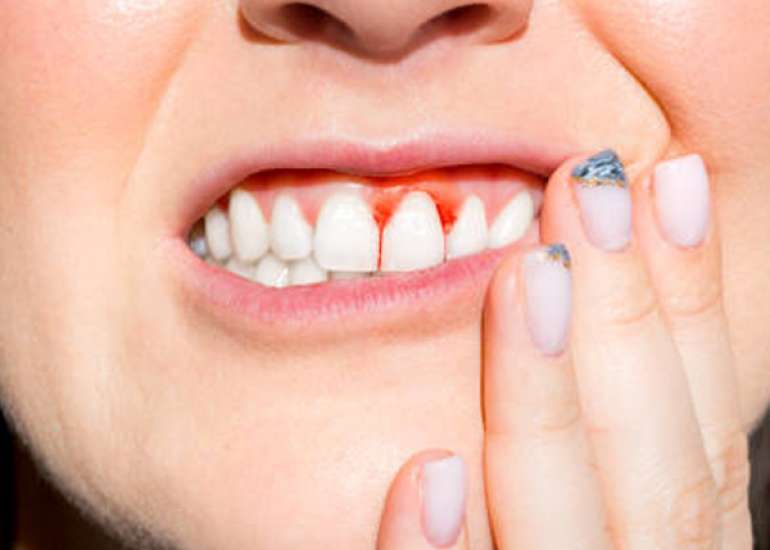 स्कर्वी क्या है? कारण, लक्षण और इलाज | What is Scurvy in Hindi